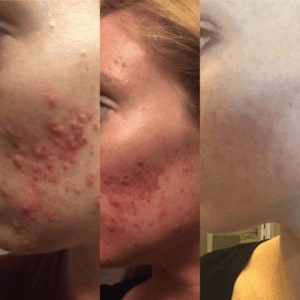 Cystic Acne Advice