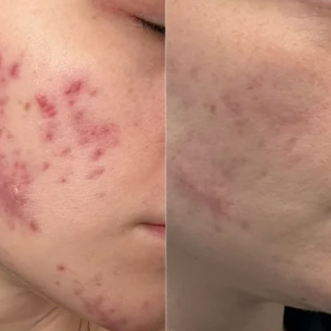 Erin before and after