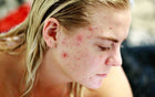 Leading Causes of Acne